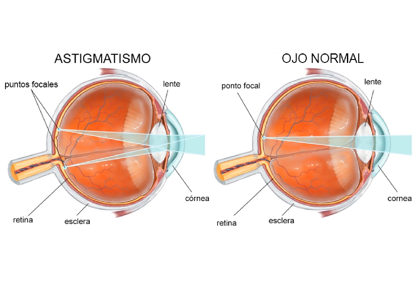 Astigmatismo – Ángel Oftalmología