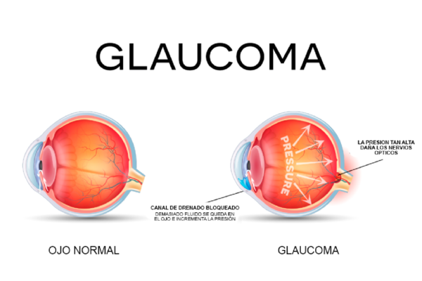 glaucom-1400x946