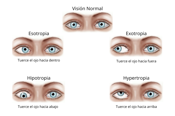 mirada-sevilla-estrabismo